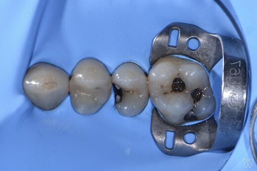 aproximal-fillings-1.jpg