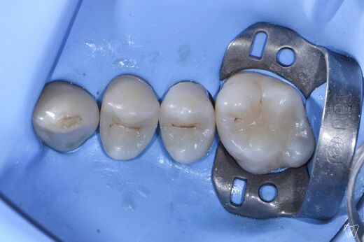 aproximal-fillings-2.jpg