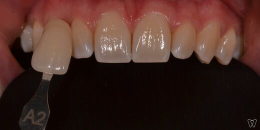 bleeching-1.jpg