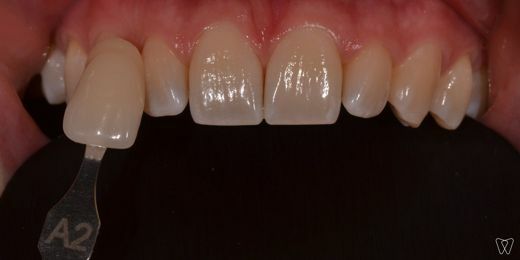 bleeching-1-test2.jpg