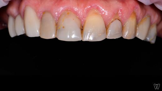 complete-upper-arch-1.jpg