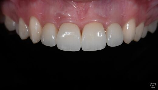 frontal-teeth-1.jpg