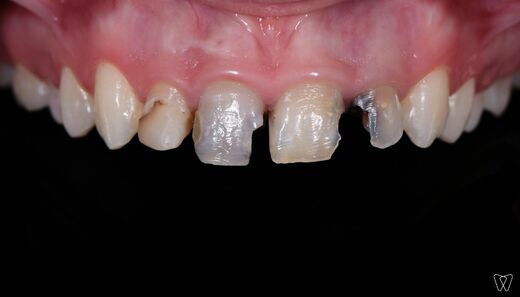 frontal-teeth-2.jpg